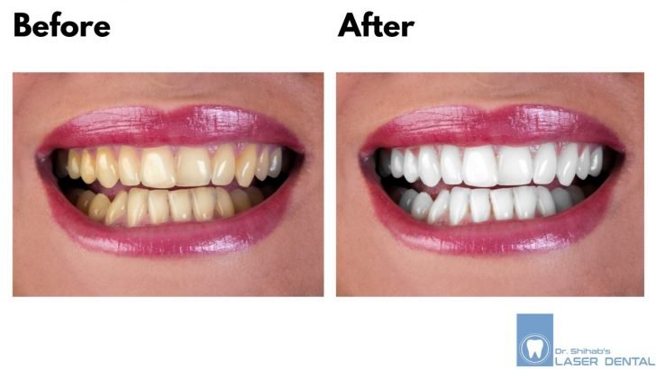 Teeth Whitening