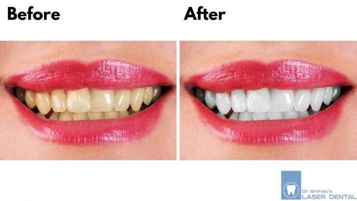 Teeth Whitening