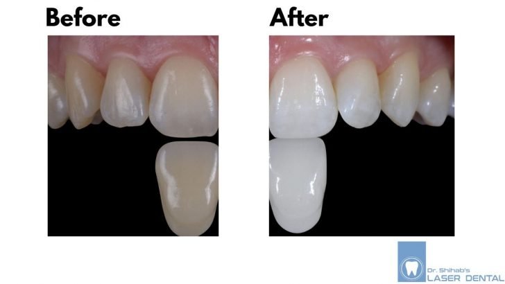 Teeth Bleaching
