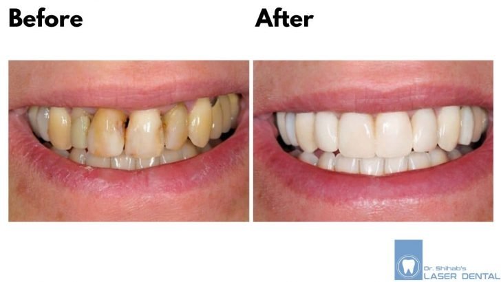 Zirconia crown