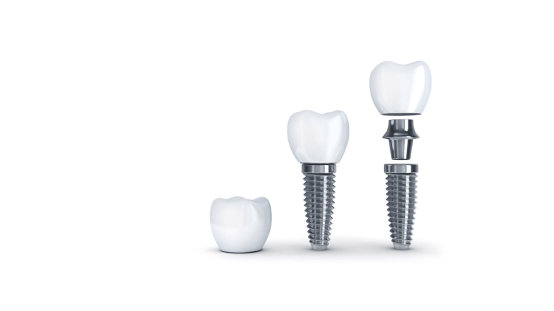 Dental Implant at LASER DENTAL clinic in Uttara Dental Implant at LASER DENTAL in Uttara