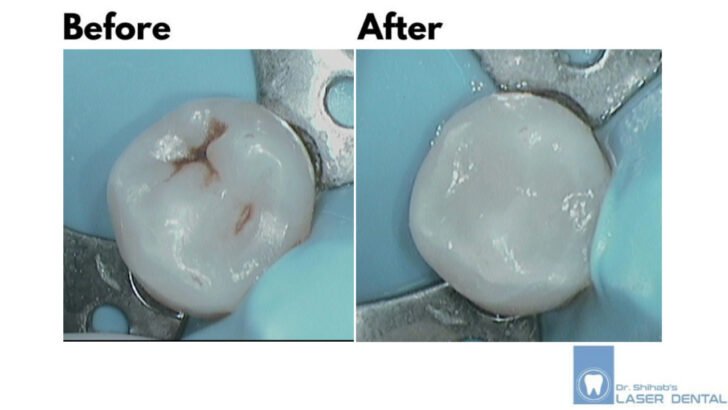 DENTAL FILLING