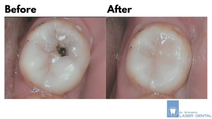 DENTAL FILLING