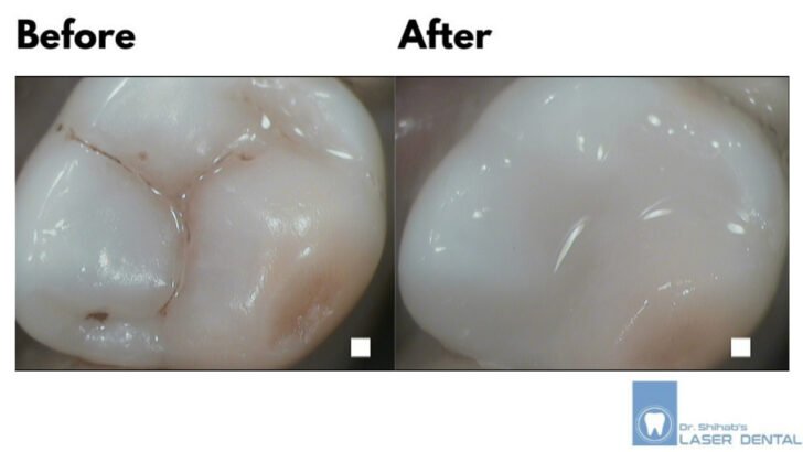DENTAL FILLING