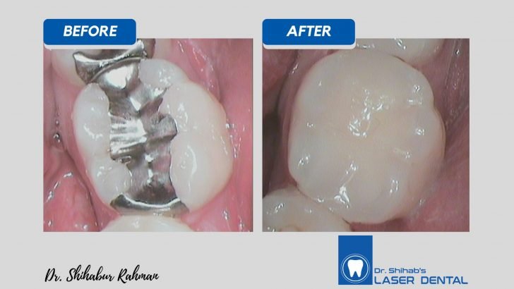 Cosmetic Dental Filling