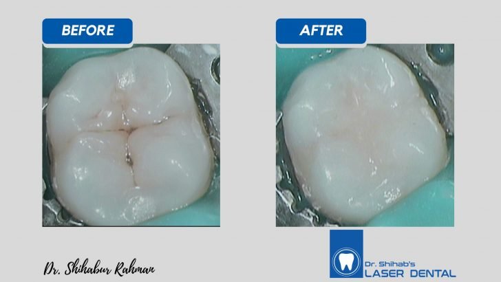 Dental Filling