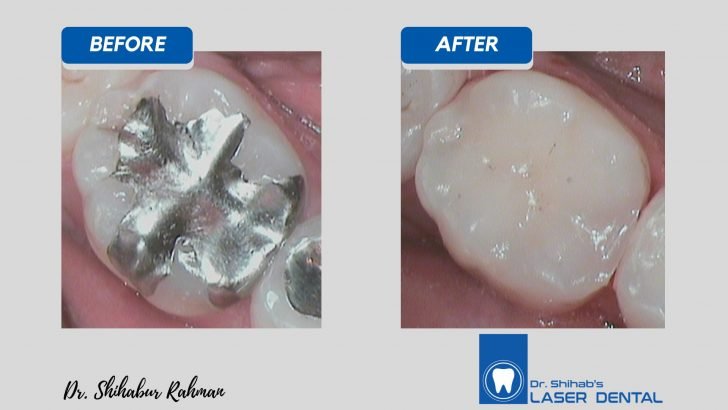 Tooth filling