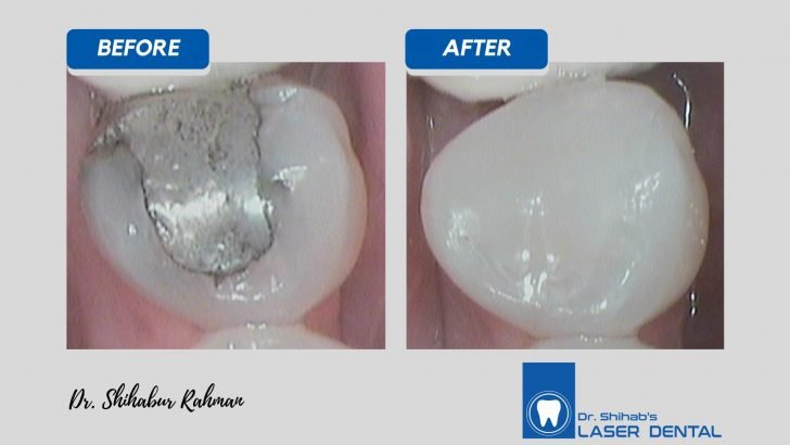 Tooth filling