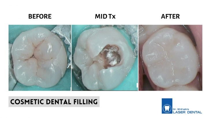DENTAL FILLING