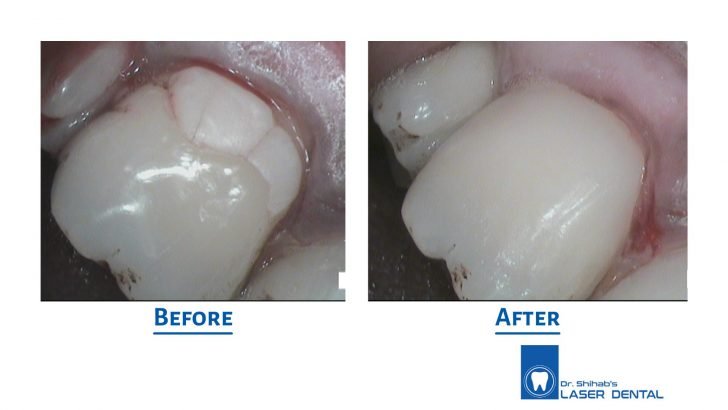 Tooth colored filling