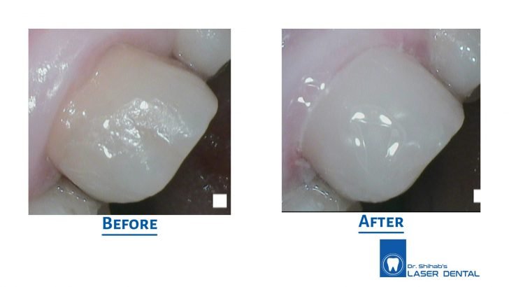 Tooth colored filling