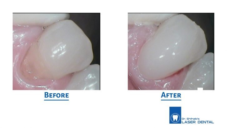Tooth colored filling
