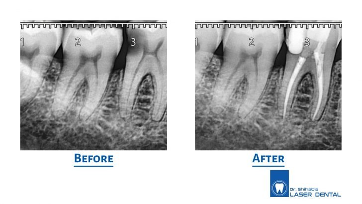 ROOT CANAL TREATMENT