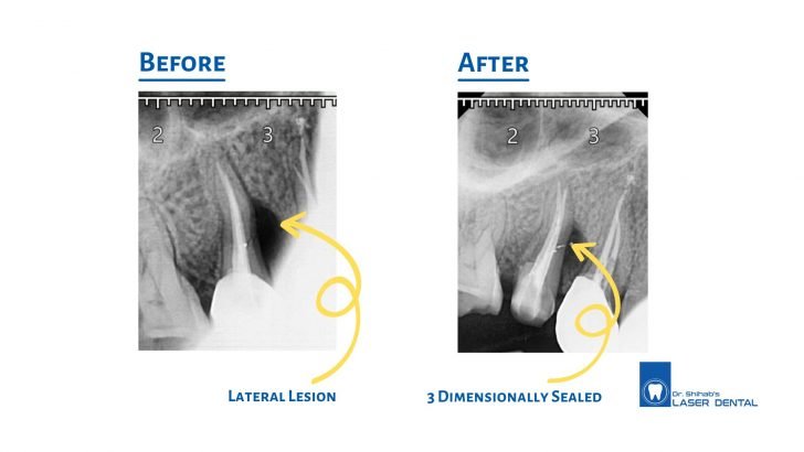 Root canal treatment
