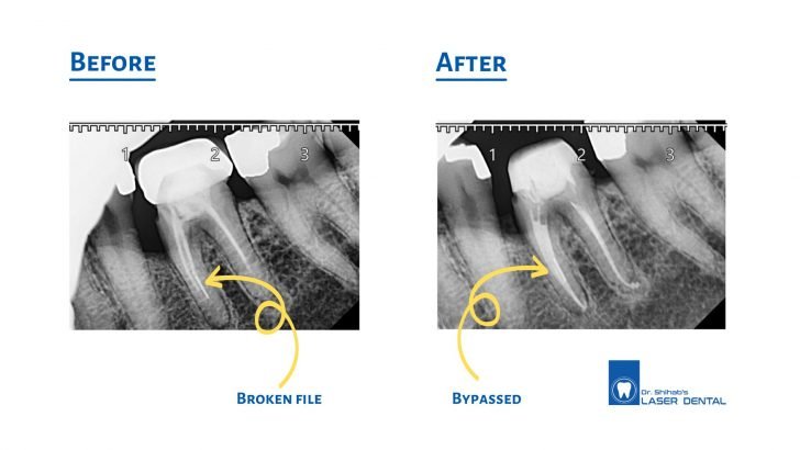 Root canal treatment