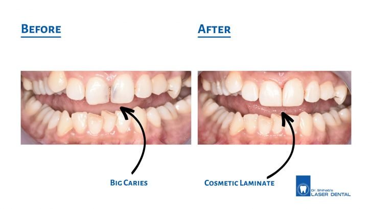 Cosmetic_composie_dental_bonding_filling