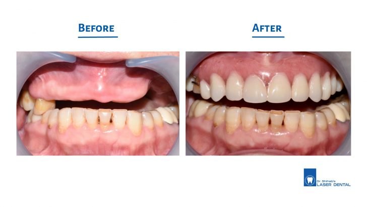 Complete Denture