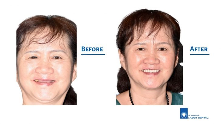 Complete Denture