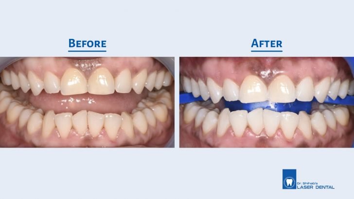 teeth whitening in Bangladesh