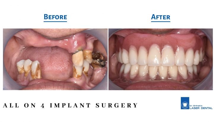 All on 4 implant surgery in Bangladesh