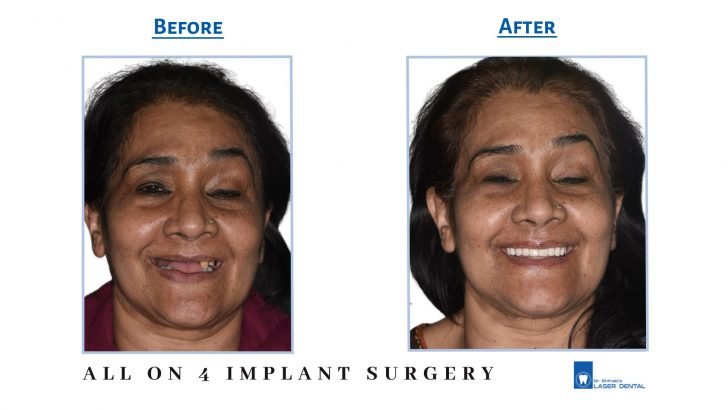 All on 4 implant surgery