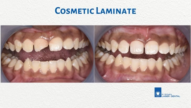 Cosmetic dental bonding