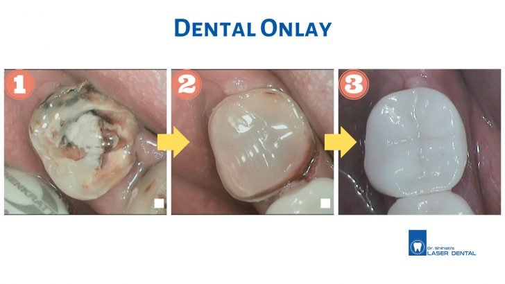 Dental Inlay & Onlay in Bangladesh