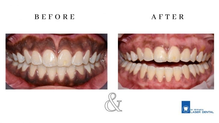Laser cosmetic gum depigmentation