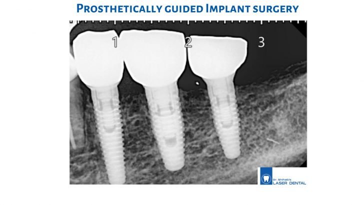 Best teeth implant treatment in Bangladesh