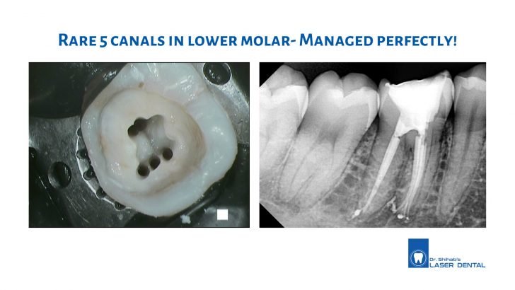 Root canal treatment