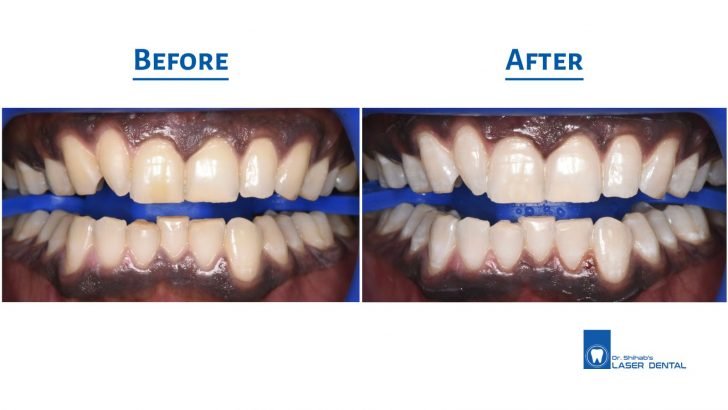 Teeth whitening