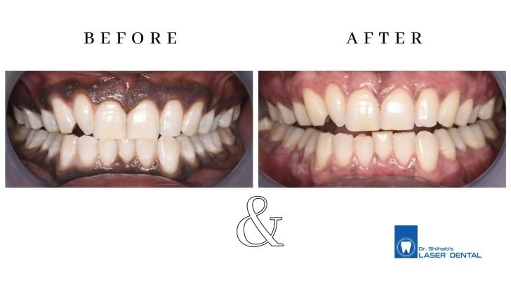 laser gum depigmentation