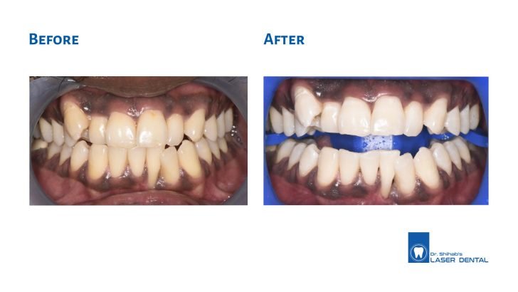 ZOOM Teeth Whitening in Bangladesh