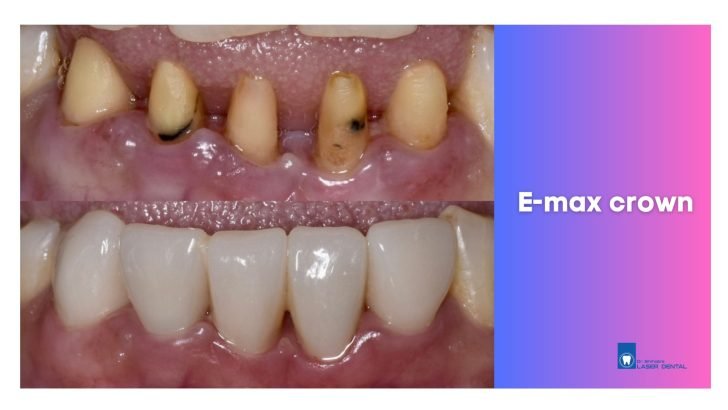 Ceramic teeth crown