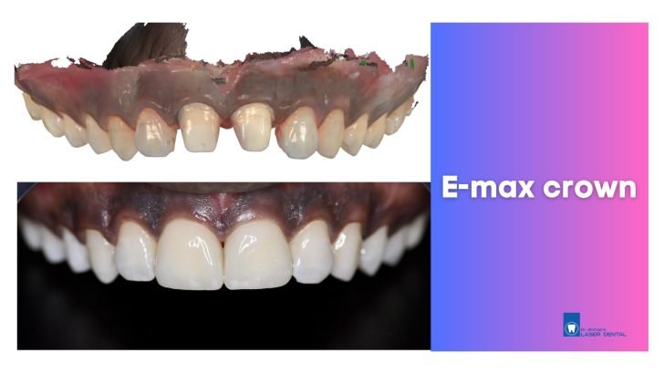 Ceramic e-max crown