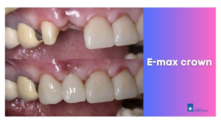 Ceramic E-max bridge
