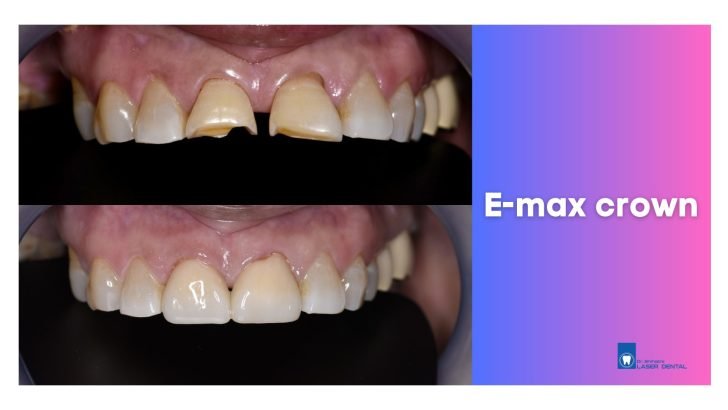 Emax dental crown