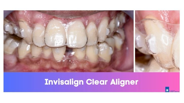 Invisalign clear aligner