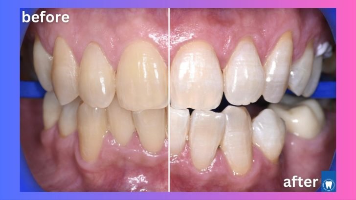 Teeth whitening