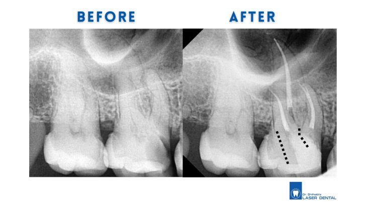 Root canal treatment
