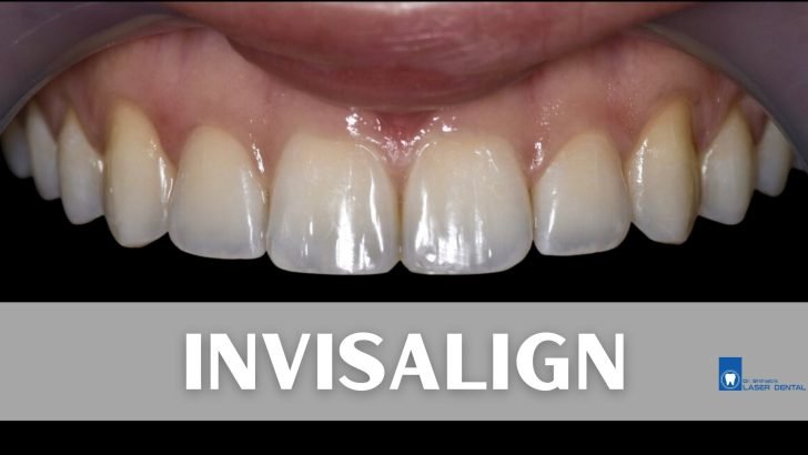 Invisalign clear aligner
