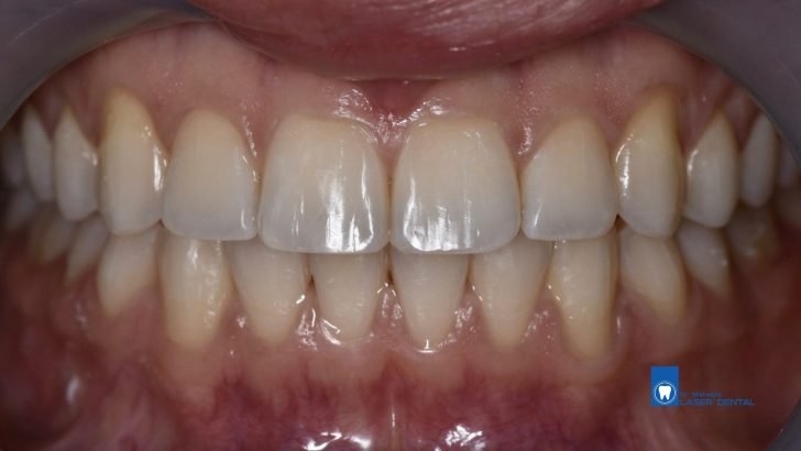 Invisalign in Bangladesh