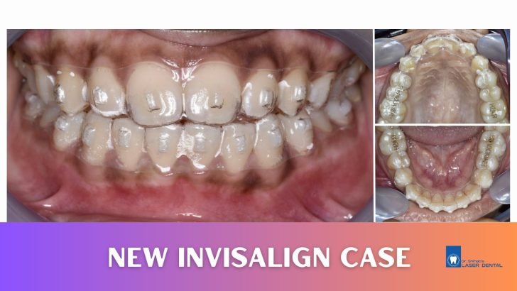 Invisalign Clear Aligner