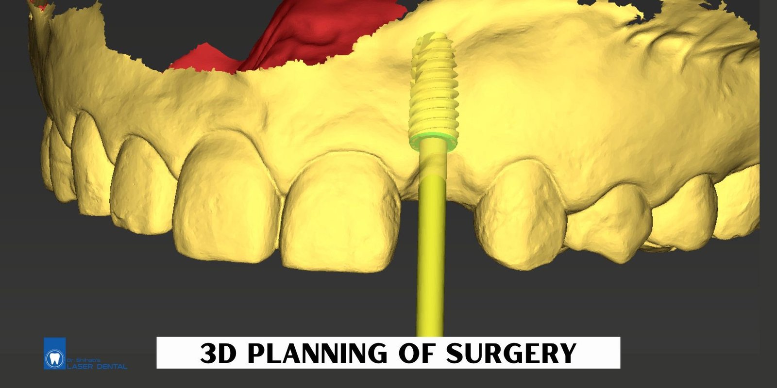 Tooth implant surgery Digital planning for guided dental implant surgery