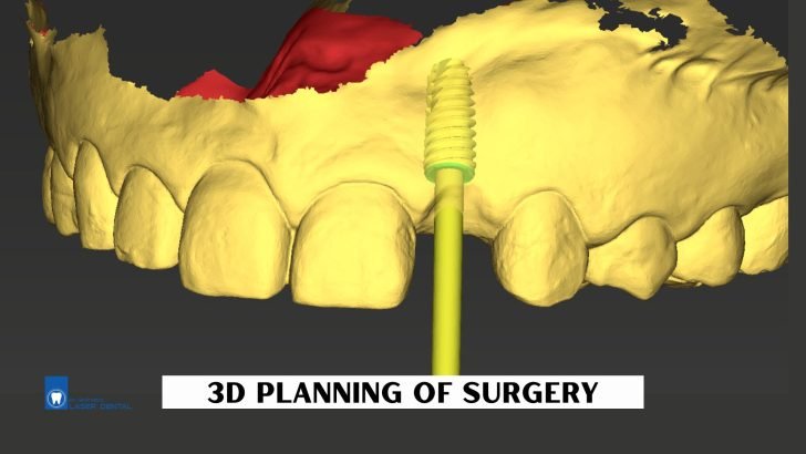 Digital planning for guided dental implant surgery