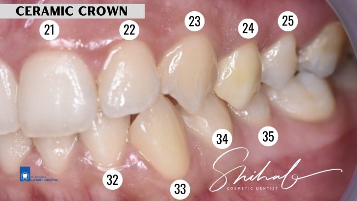 Best ceramic crown in Bangladesh
