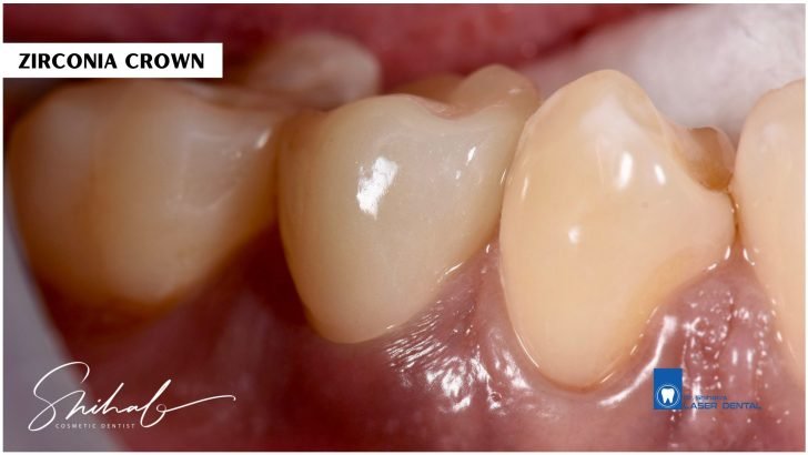 Zirconia crown at laser dental in bangladesh