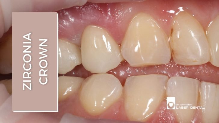 zirconia crown