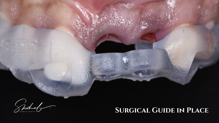 Guided tooth implant surgery in Bangladesh
