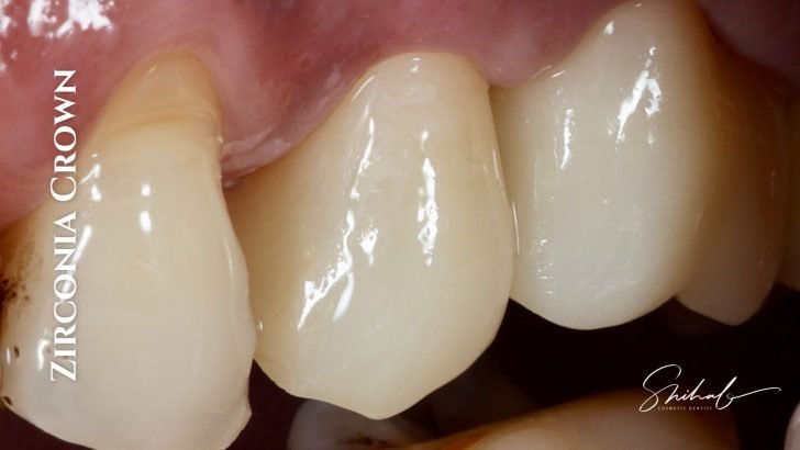 Emax crown at LASER DENTAL_best dental clinic in bangladesh